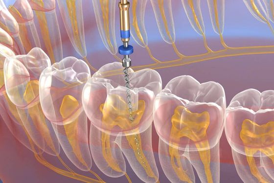 Endodontic retreatments