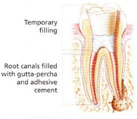 Endodontic Procedure