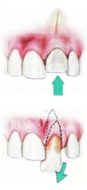 Dislodged Teeth