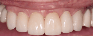 Cosmetic Dentistry After