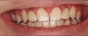 Cosmetic Dentistry After