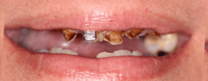 CONVENTIONAL DENTURES BEFORE