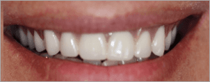 CONVENTIONAL DENTURES AFTER