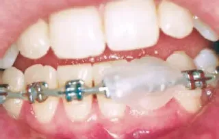 Irritation in mouth