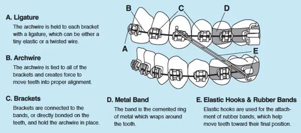 Braces guide