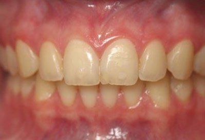 class II malocclusion after
