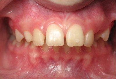 class II malocclusion before