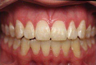 impacted canines after