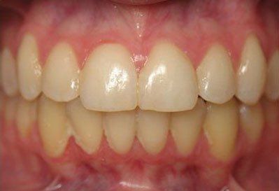 impacted canines after