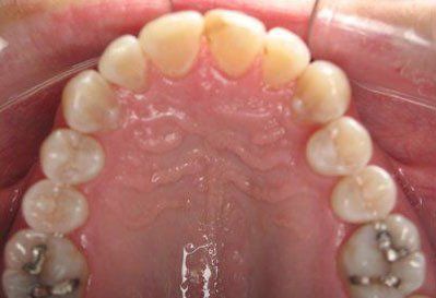 invisalign after