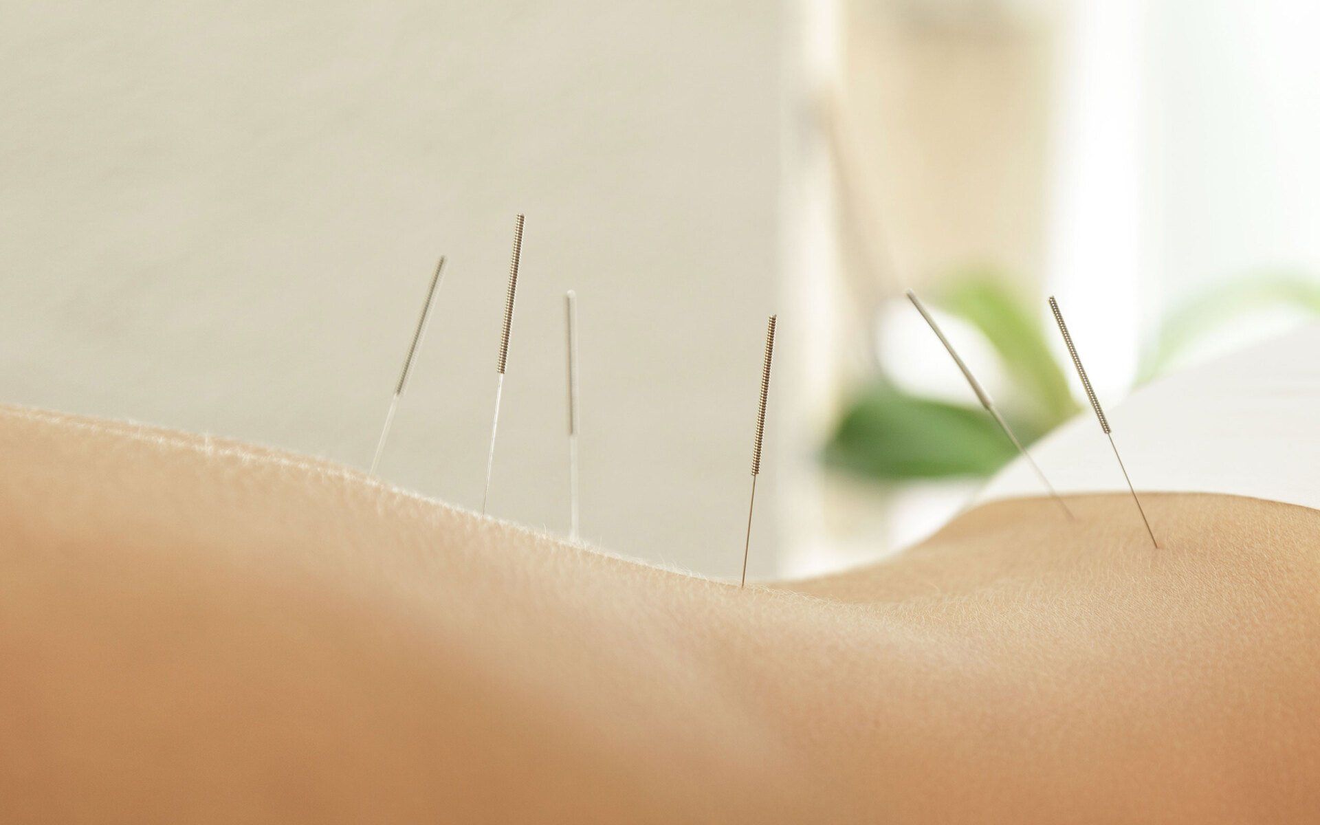 Acupuncture service