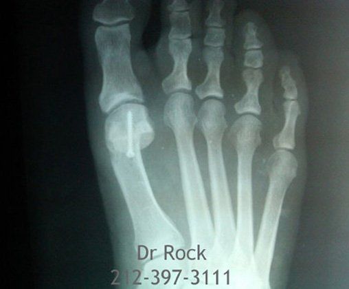 Footwork X-ray