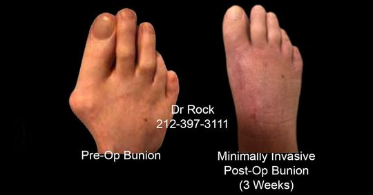 Before and After Bunion Pictures