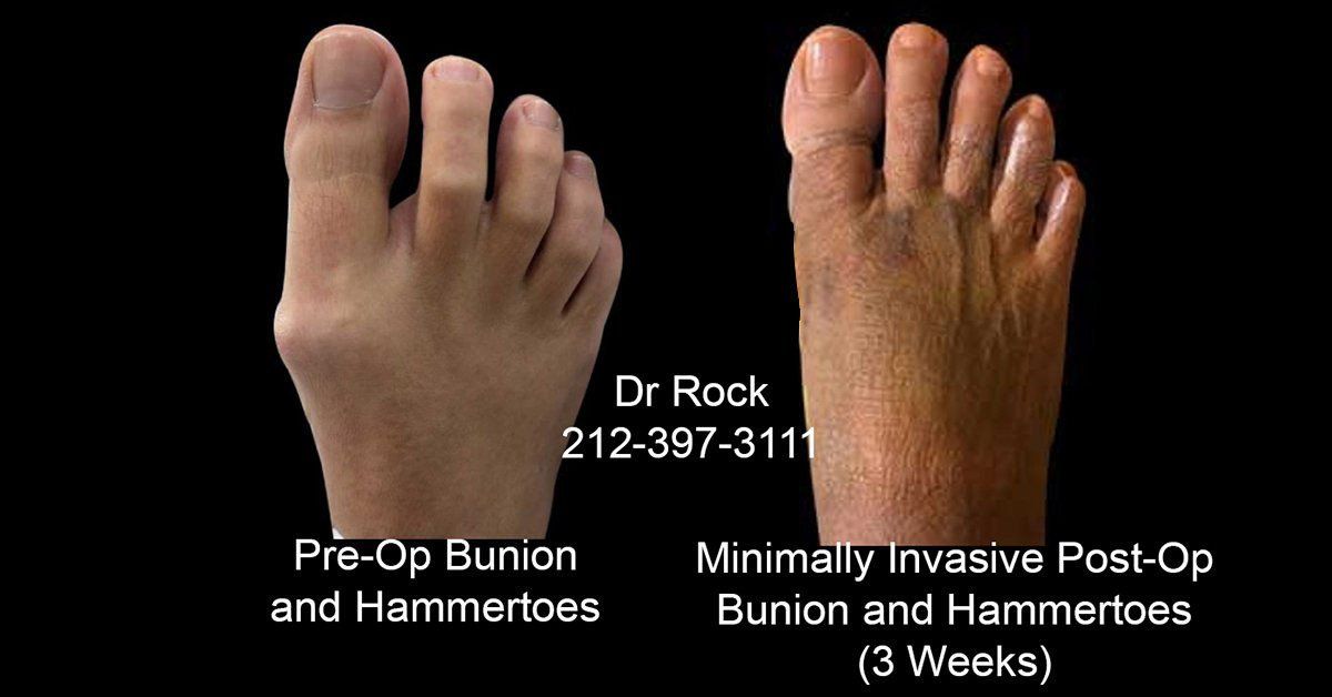 Before and After Bunion and Hammertoes