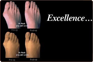 Hammer Toes/Claw Toes - Dr Warren