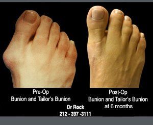 Before and after footwork