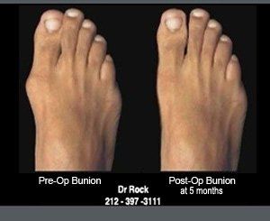 Before and after footwork