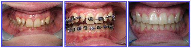 Dental Procdures Before and After Photo Gallery | Ogdensburg, NY | Christopher LaFlair DDS PC | 315-393-2240