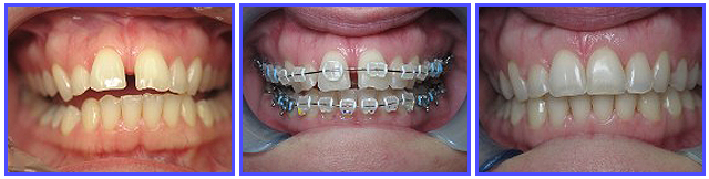 Dental Procdures Before and After Photo Gallery | Ogdensburg, NY | Christopher LaFlair DDS PC | 315-393-2240