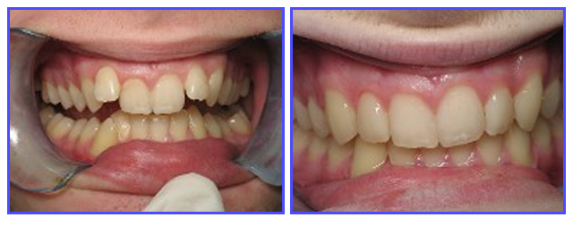 Dental Procdures Before and After Photo Gallery | Ogdensburg, NY | Christopher LaFlair DDS PC | 315-393-2240