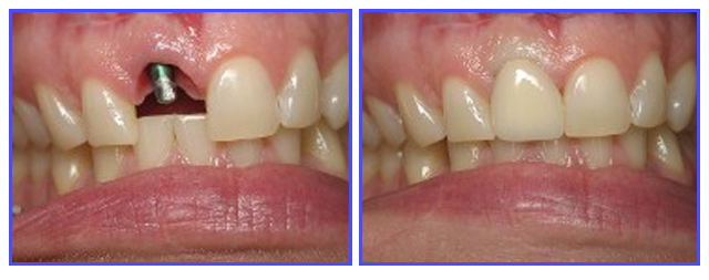 Dental Procdures Before and After Photo Gallery | Ogdensburg, NY | Christopher LaFlair DDS PC | 315-393-2240