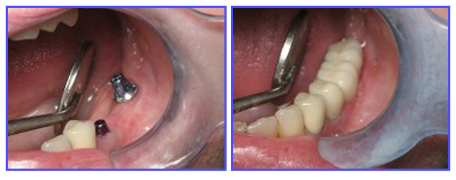 Dental Procdures Before and After Photo Gallery | Ogdensburg, NY | Christopher LaFlair DDS PC | 315-393-2240