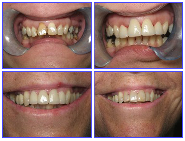 Dental Procdures Before and After Photo Gallery | Ogdensburg, NY | Christopher LaFlair DDS PC | 315-393-2240