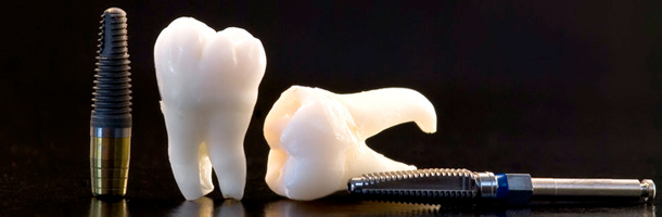 Dental artificial implants