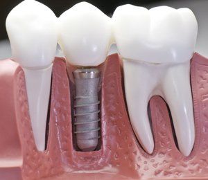 Single tooth restoration