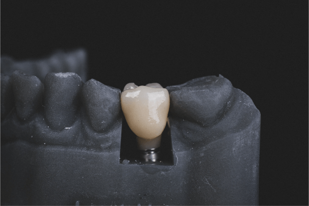 X-Ray of tooth replacement within the mouth