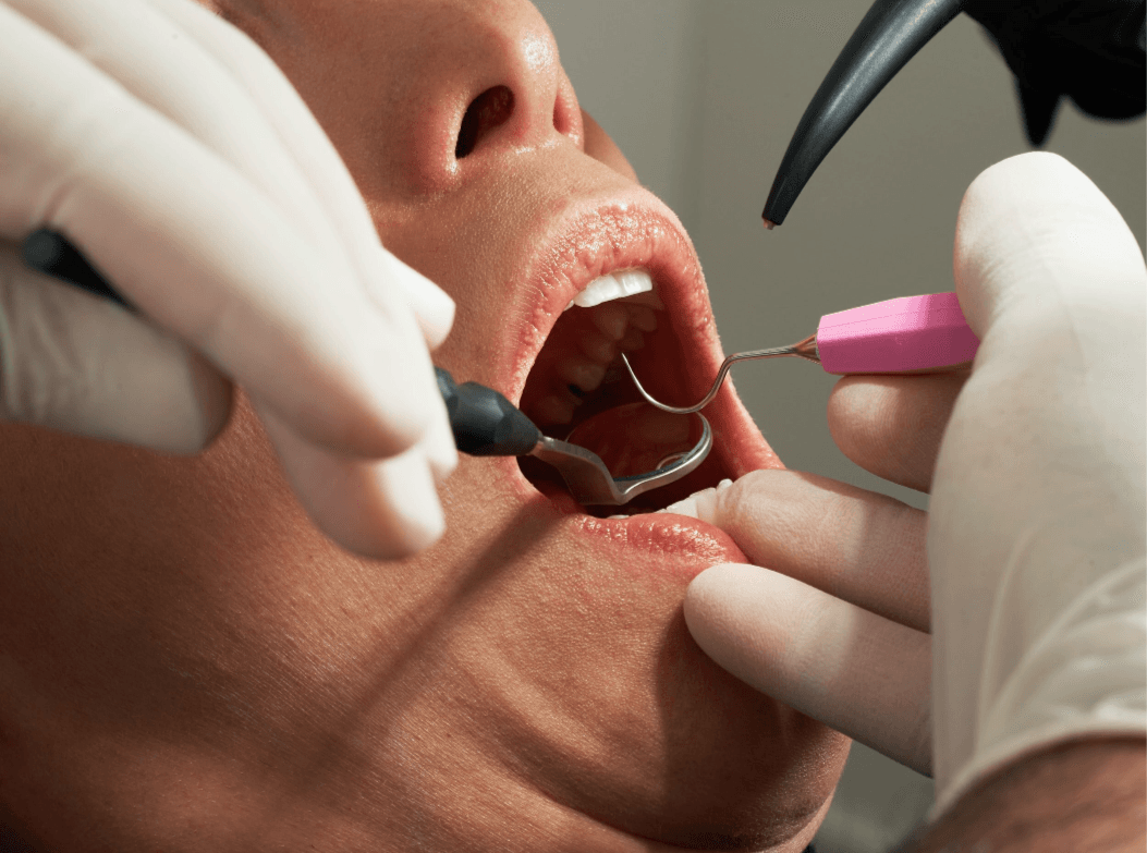 ongoing dental mouth cleaning