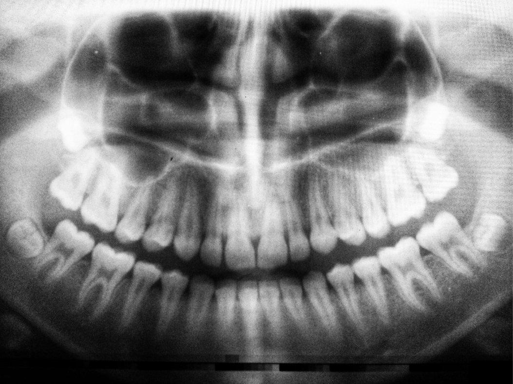 X-Rays of inside mouth