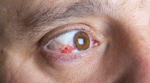 Eye injury