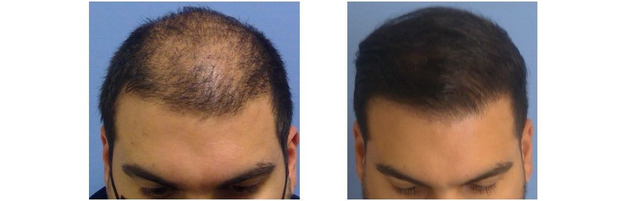 A before and after picture of a man 's hair growth.