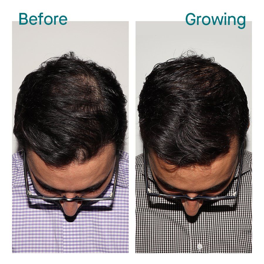 Male 10 months on Nutrafol