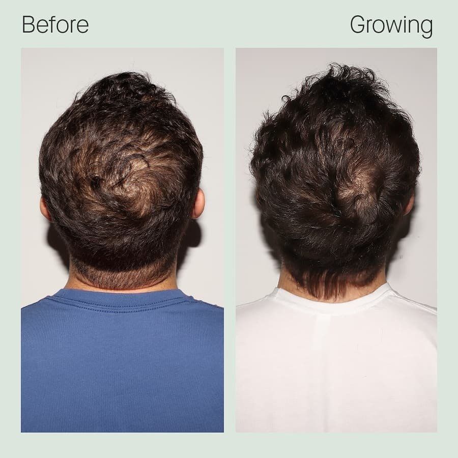Male 3 months on Nutrafol