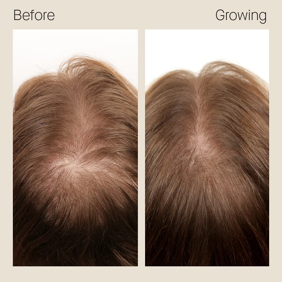 Female 8 months on Nutrafol