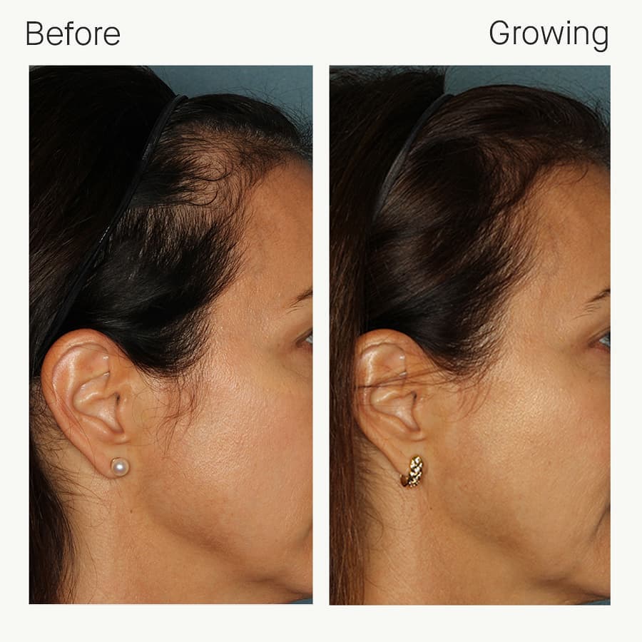 Female 6 months on Nutrafol