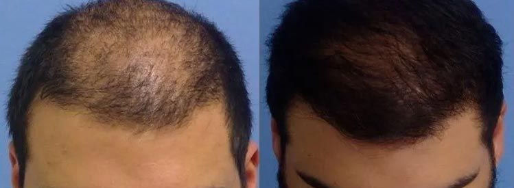 6 months after hair restoration