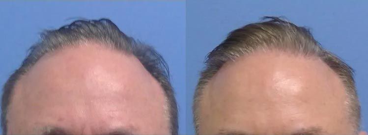 1 year after hair restoration