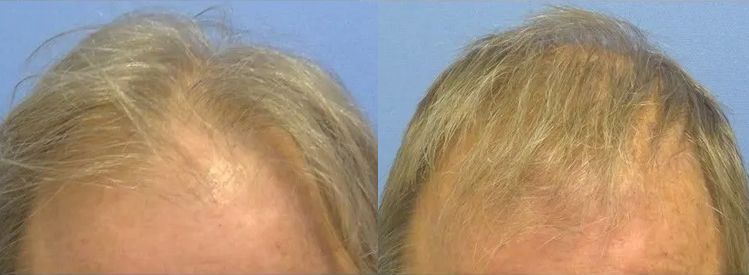 Men's hair restoration