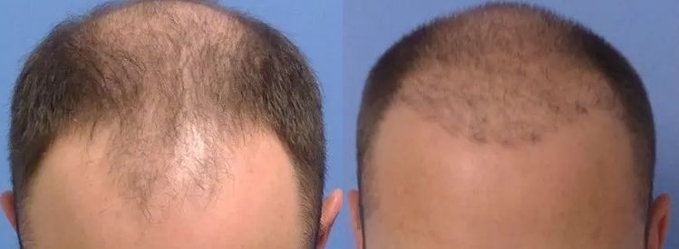 6 months hair restoration
