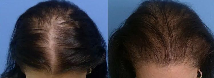 Hair restoration