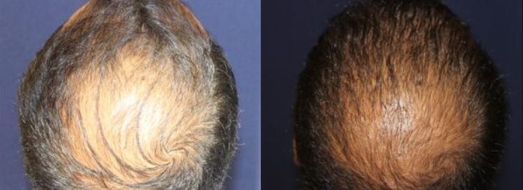 Hair restoration