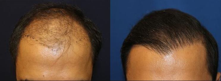Hair restoration