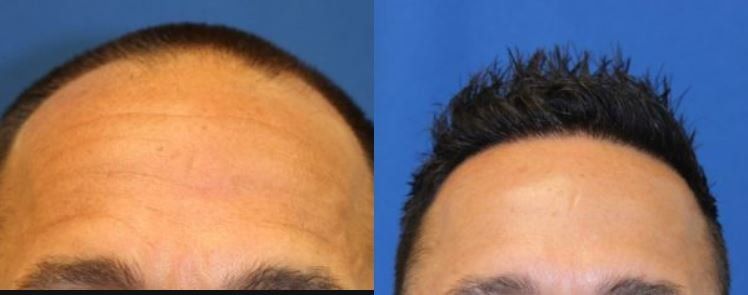 Hair restoration