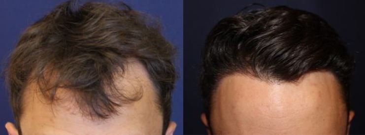 Hair restoration
