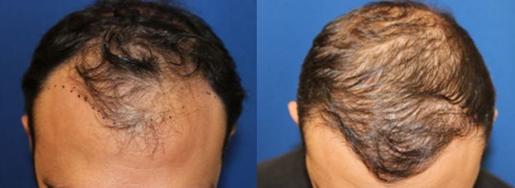 Hair restoration