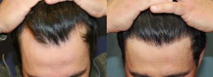 Hair restoration