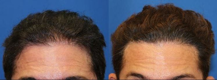 Hair restoration